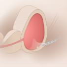 схема поставновки стента Allium URS