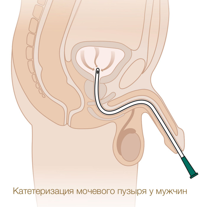 Катетер урологический Нелатона лубрицированный 16 Ch/Fr