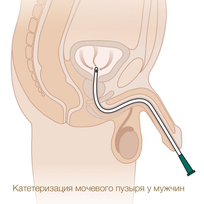 Катетер урологический Нелатона лубрицированный 8 Ch/Fr